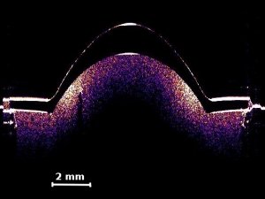Thickness_Intra-ocular-lens-300x225.jpg